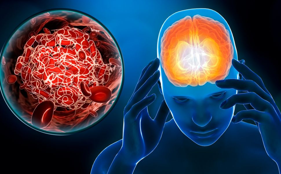 Ce este accidentul vascular cerebral
