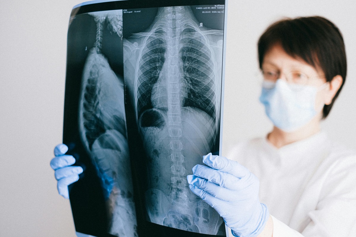 Tuberculoza afectează anual aproximativ 10 milioane de persoane. Foto: pexels.com
