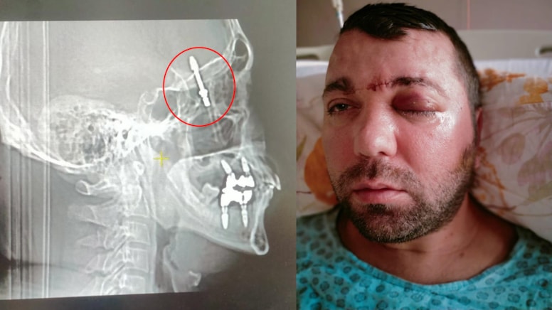 Un șurub a ajuns în craniul pacientului. Foto: Demokrat Gündem