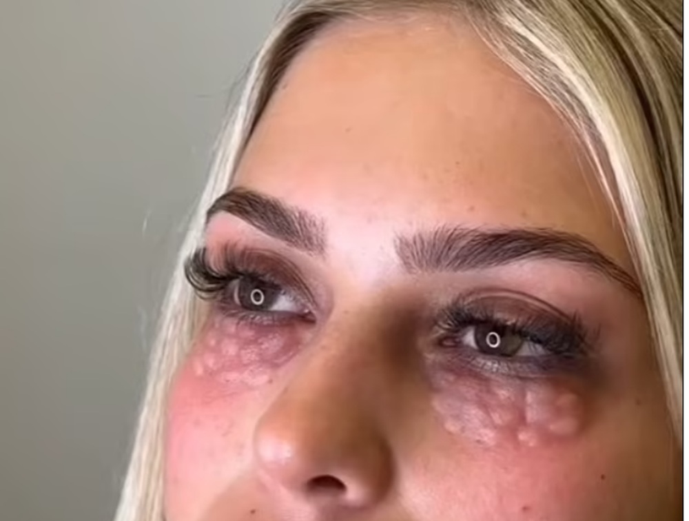 O procedură cosmetică riscantă din anii '50