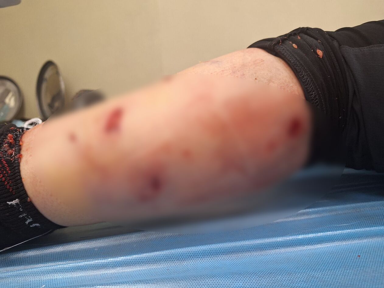 O clujeancă a fost atacată de o haită de câini