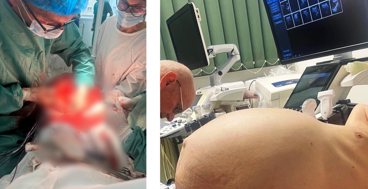 Tumoare de 25 de kilograme