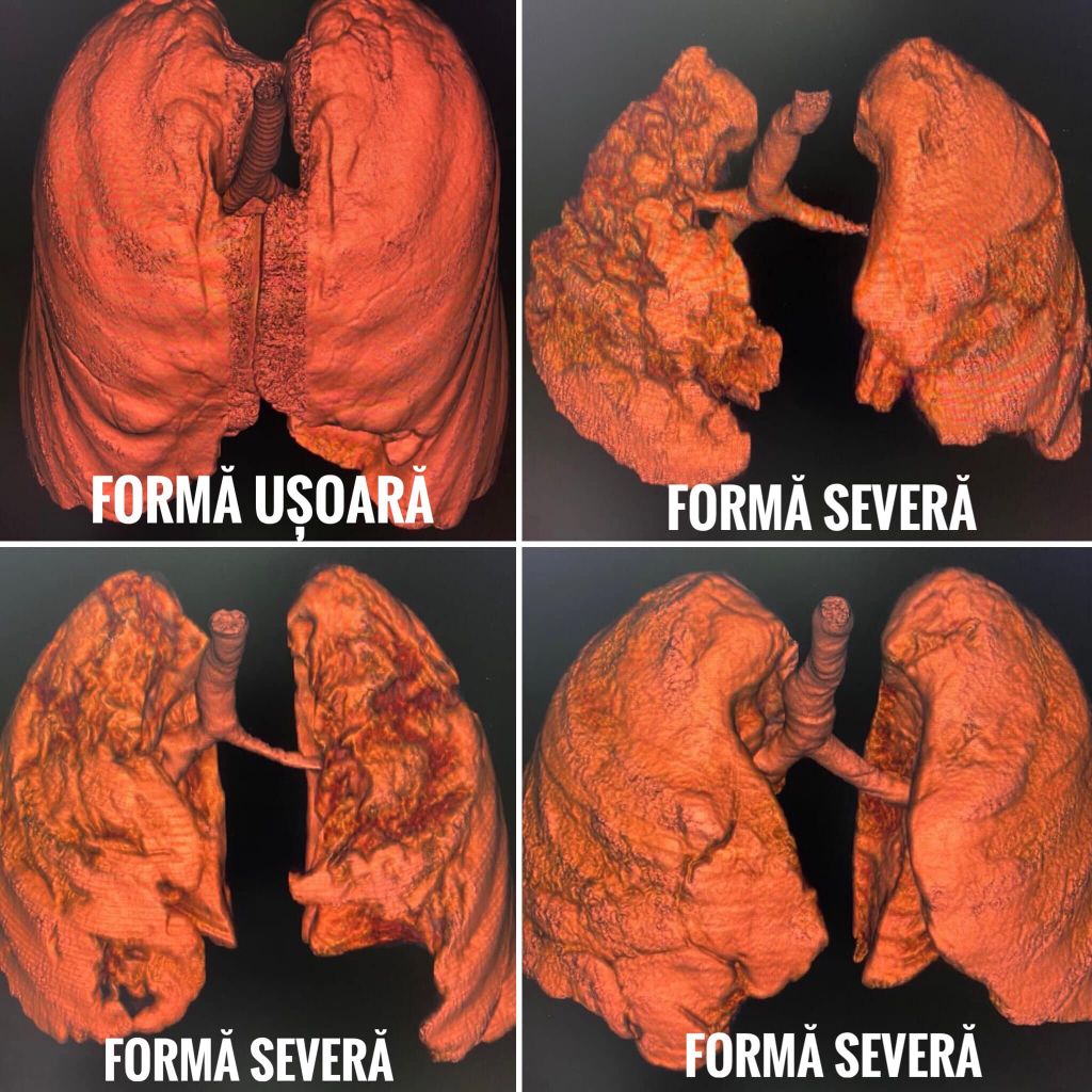 dar infectate cu Covid. Imagini cu tomografiile unor pacienți
